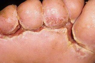 Συμπτώματα μύκητα στα νύχια των ποδιών