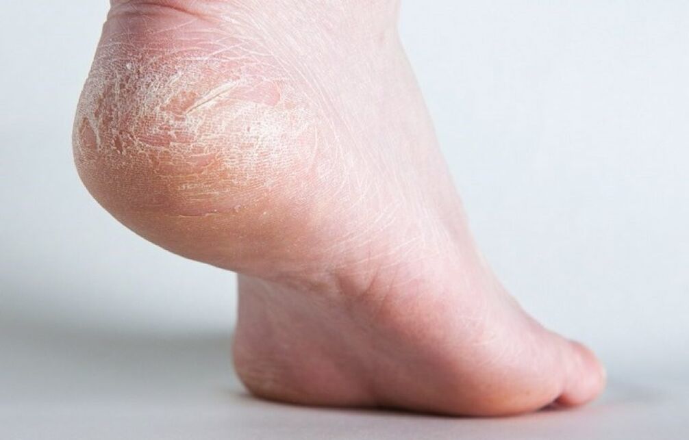πώς να αντιμετωπίσετε τον μύκητα του δέρματος στα πόδια