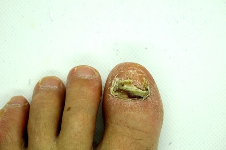 Fingernail Fungus - βαρύ στάδιο