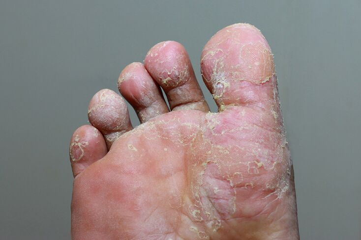 Βαρύ στάδιο του Foxgust of Mycosis