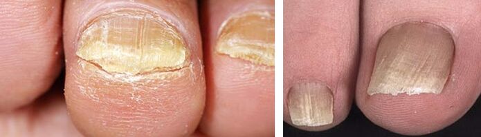 Βλάβη στα νύχια από μυκητιασική λοίμωξη